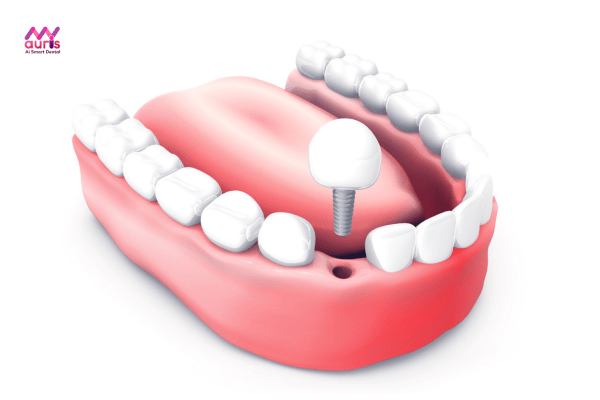 Trồng implant sau khi nhổ răng giúp cải thiện thẩm mỹ, ăn nhai, ngăn ngừa tiêu xương, biến chứng