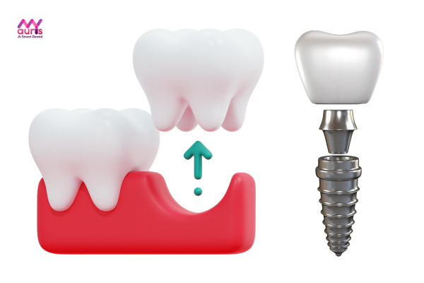 Sau khi nhổ răng bao lâu thì trồng implant? 