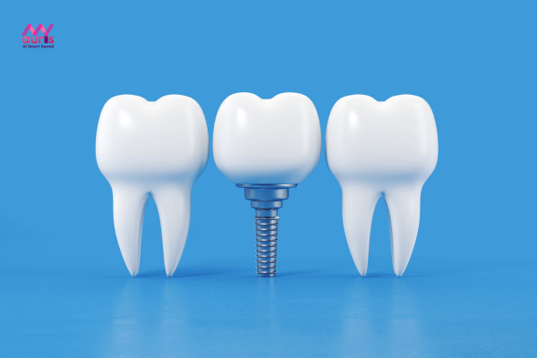 Sau khi nhổ răng bao lâu thì trồng implant với implant thông thường? 