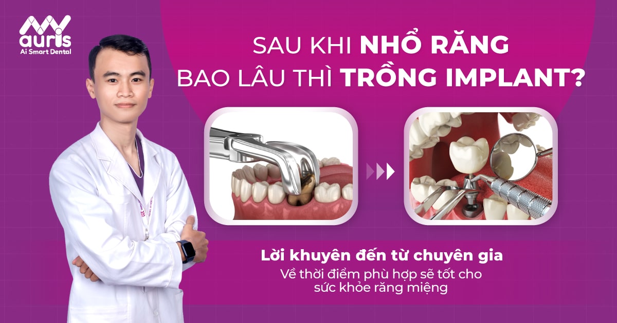 sau khi nhổ răng bao lâu thì trồng implant?