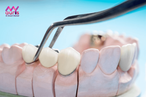 Hỏi đáp tại sao răng sứ kim loại bị đen viền nướu?