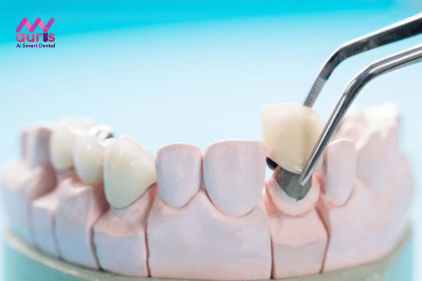 Khắc phục răng sứ kim loại bị đen bằng cách nào?