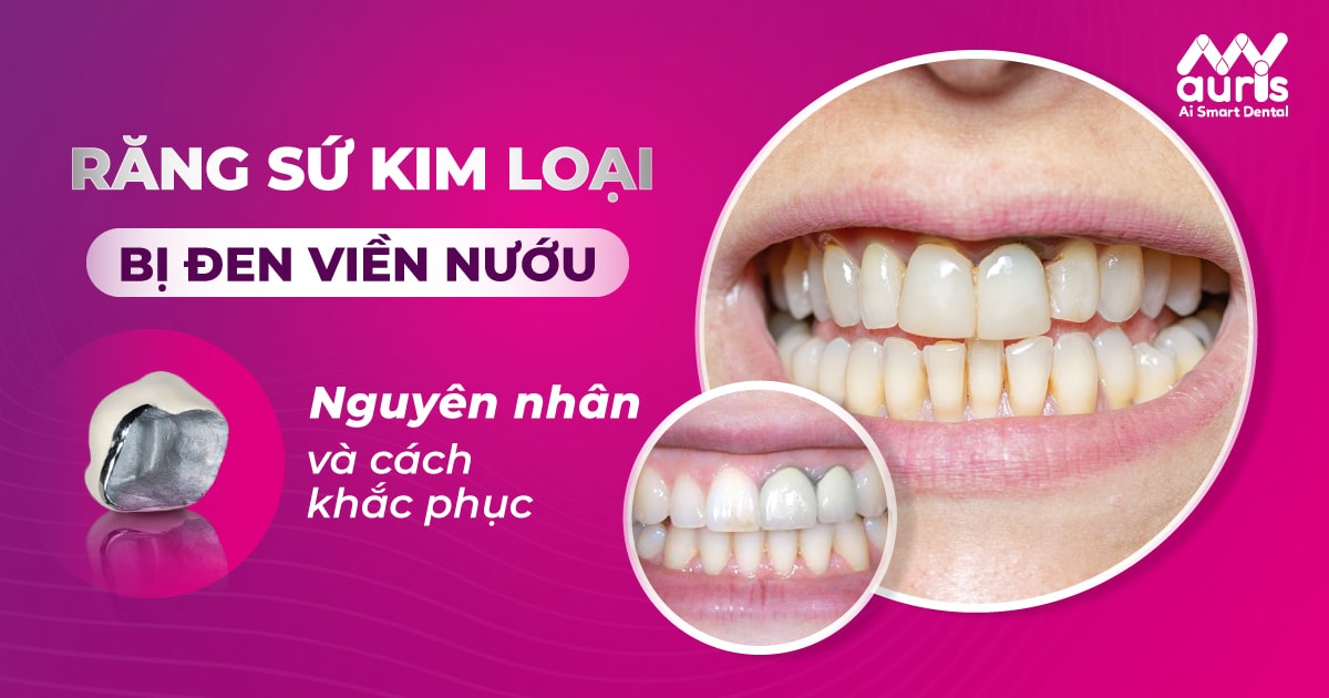 Răng sứ kim loại bị đen: Nguyên nhân và cách khắc phục