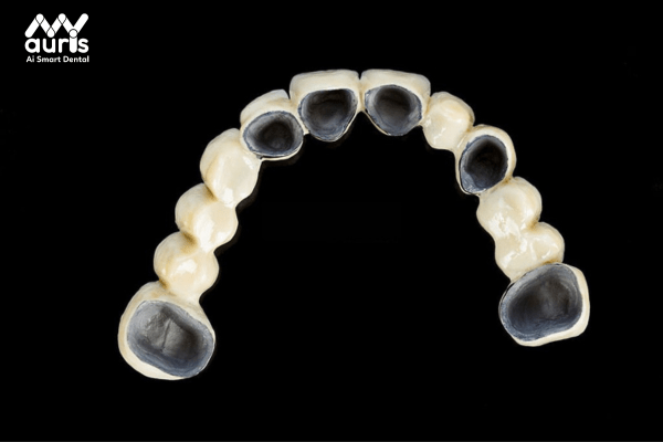 Tìm hiểu về các loại răng sứ - Răng sứ kim loại