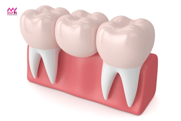 Trồng răng hàm được bao lâu? Cầu răng sứ