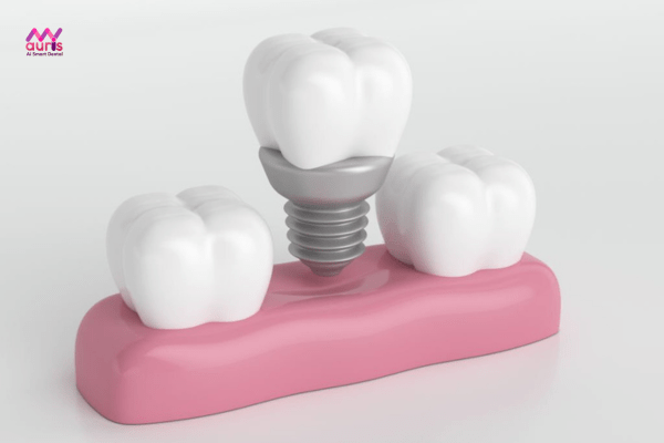 Tại sao trồng răng hàm bằng implant bền hơn các phương pháp khác? 