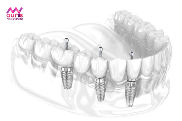trồng răng hàm giá bao nhiêu 1 cái? - Cấy ghép Implant
