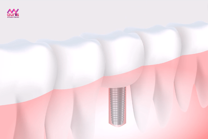 Trồng răng implant - Trồng răng hàm giả cố định 