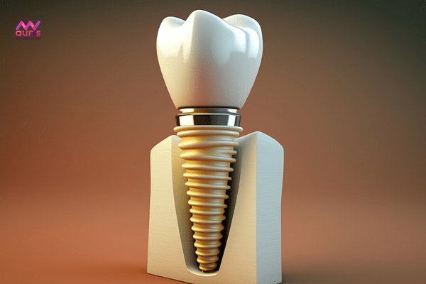 Trồng răng implant - Trồng răng hàm hết bao nhiêu tiền?