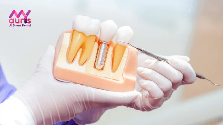 trồng răng hàm implant giá bao nhiêu