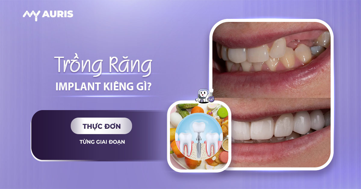 trồng răng implant kiêng gì,cắm implant cần kiêng gì,cắm implant kiêng gì,cắm implant xong kiêng ăn gì