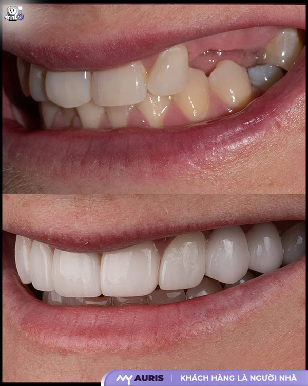 trồng răng implant kiêng gì,cắm implant cần kiêng gì,cắm implant kiêng gì,cắm implant xong kiêng ăn gì