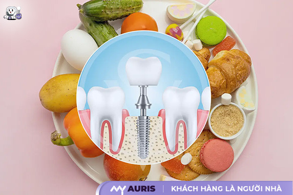 trồng răng implant kiêng gì,cắm implant cần kiêng gì,cắm implant kiêng gì,cắm implant xong kiêng ăn gì