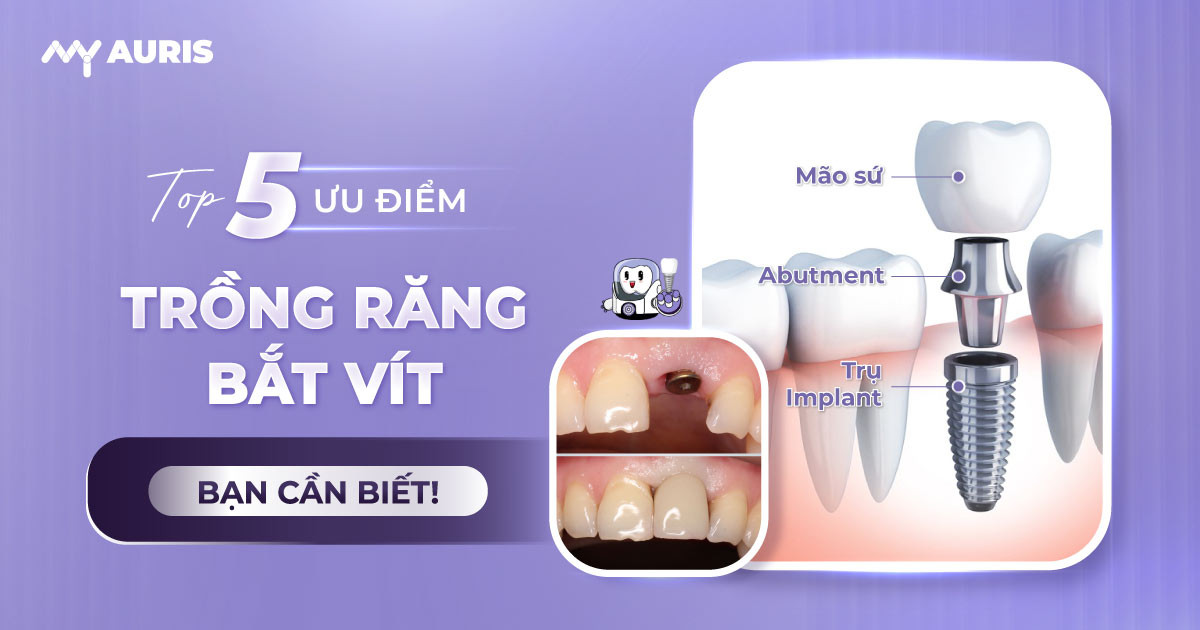 ưu điểm trồng răng bắt vít,trồng răng implant xi măng