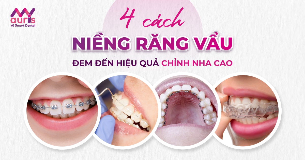 4 cách niềng răng vẩu đem đến hiệu quả chỉnh nha cao