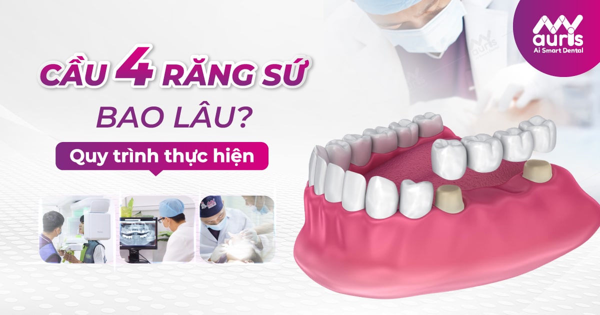 cầu 4 răng sứ bao lâu