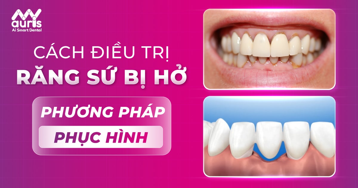 cầu răng sứ bị hở