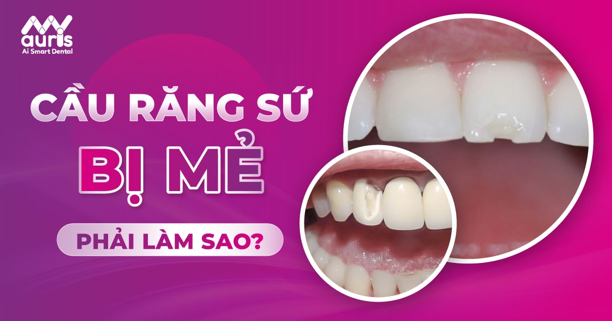 cầu răng sứ bị mẻ