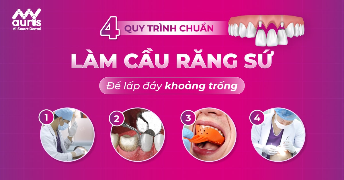 cầu răng sứ lấp đầy khoảng trống