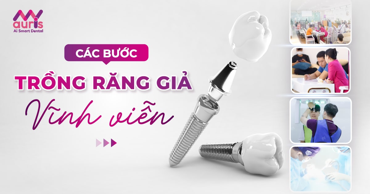 các bước trồng răng giả