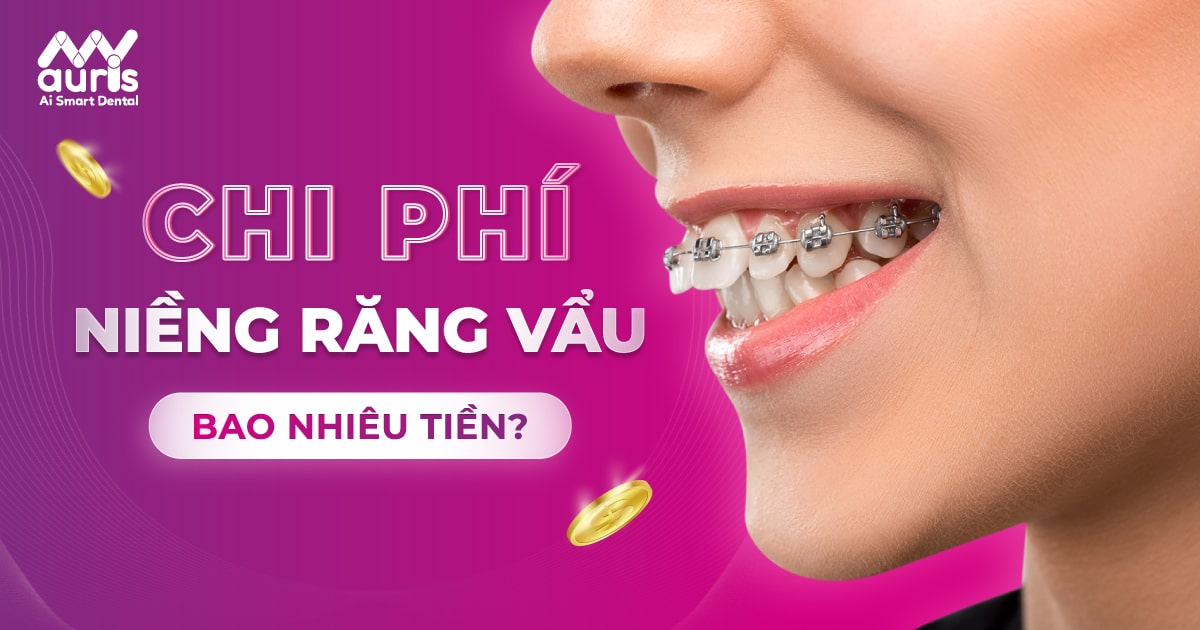 chi phí niềng răng vẩu