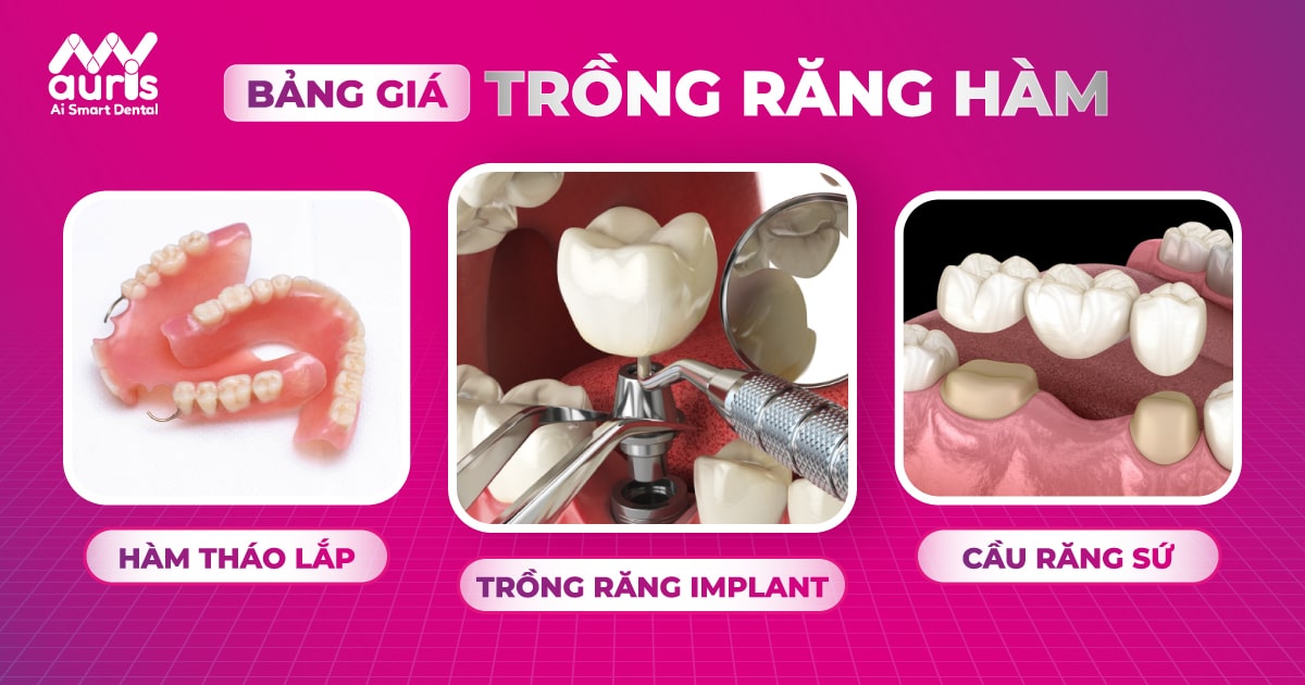 Bảng giá trồng răng hàm từ 3 kỹ thuật trong nha khoa