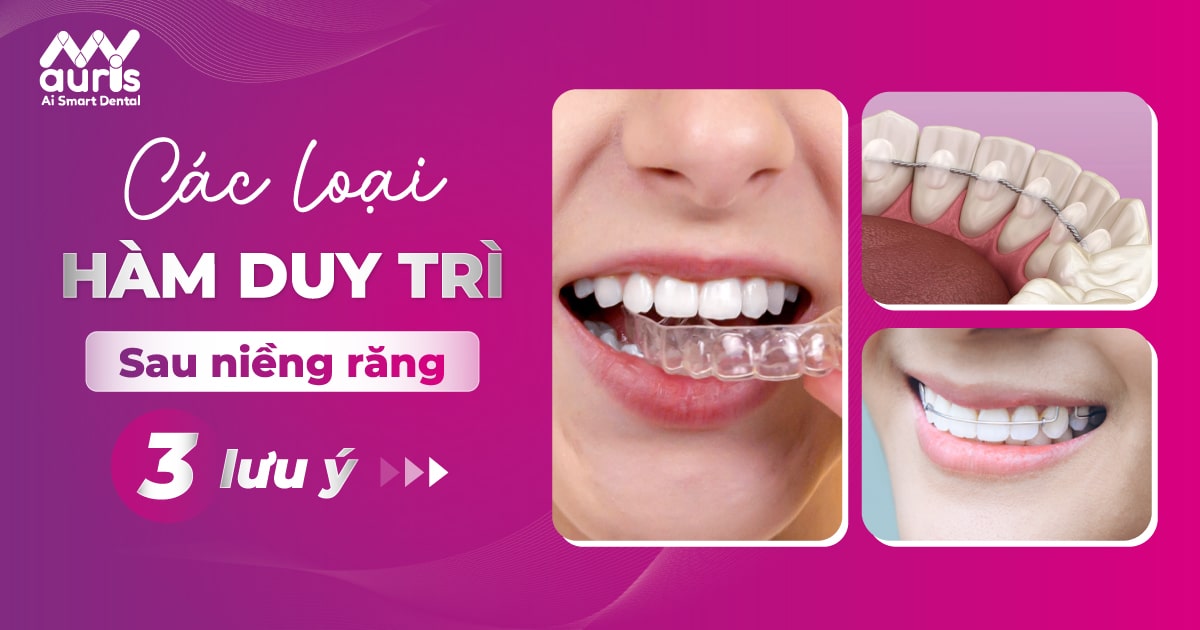 Các loại hàm duy trì sau niềng răng - 3 lưu ý cần nhớ