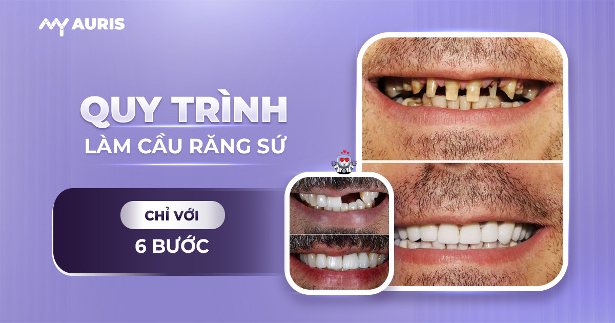 cầu răng sứ lấp đầy khoảng trống,quy trình làm cầu răng sứ