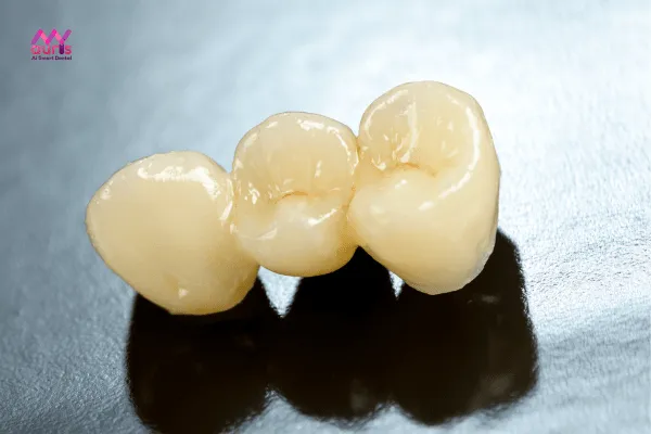 Chất liệu răng sứ - yếu tố tác động đến cầu răng sứ tồn tại bao lâu 