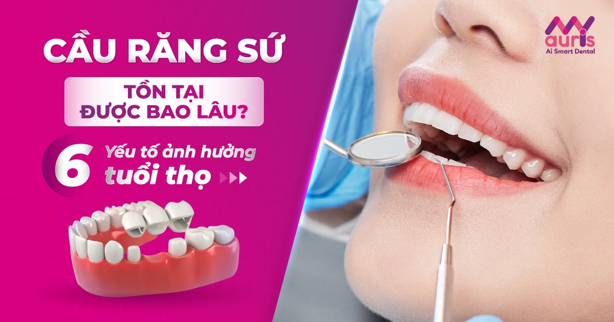 Cầu răng sứ tồn tại được bao lâu