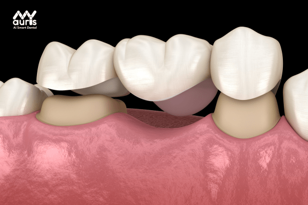 Cầu răng sứ truyền thống là gì?