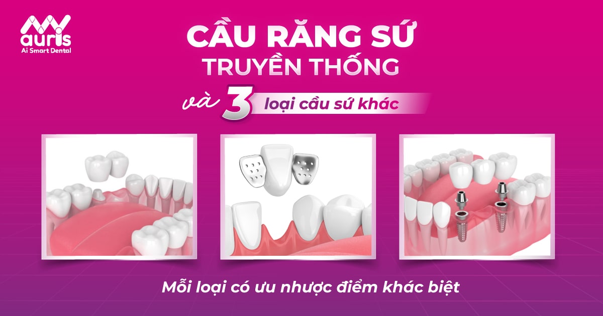 Cầu răng sứ truyền thống