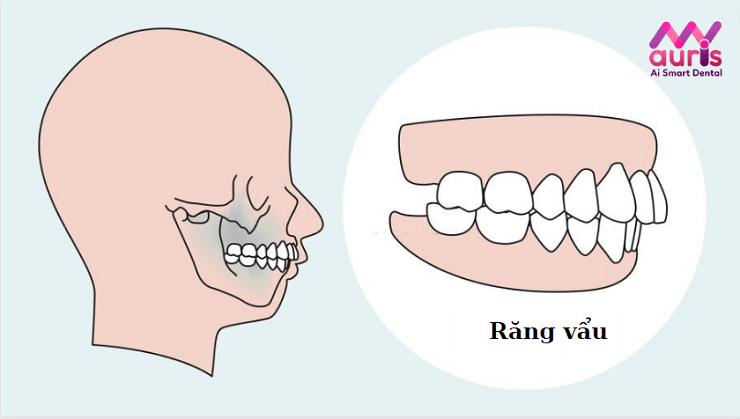 chi phí niềng răng vẩu