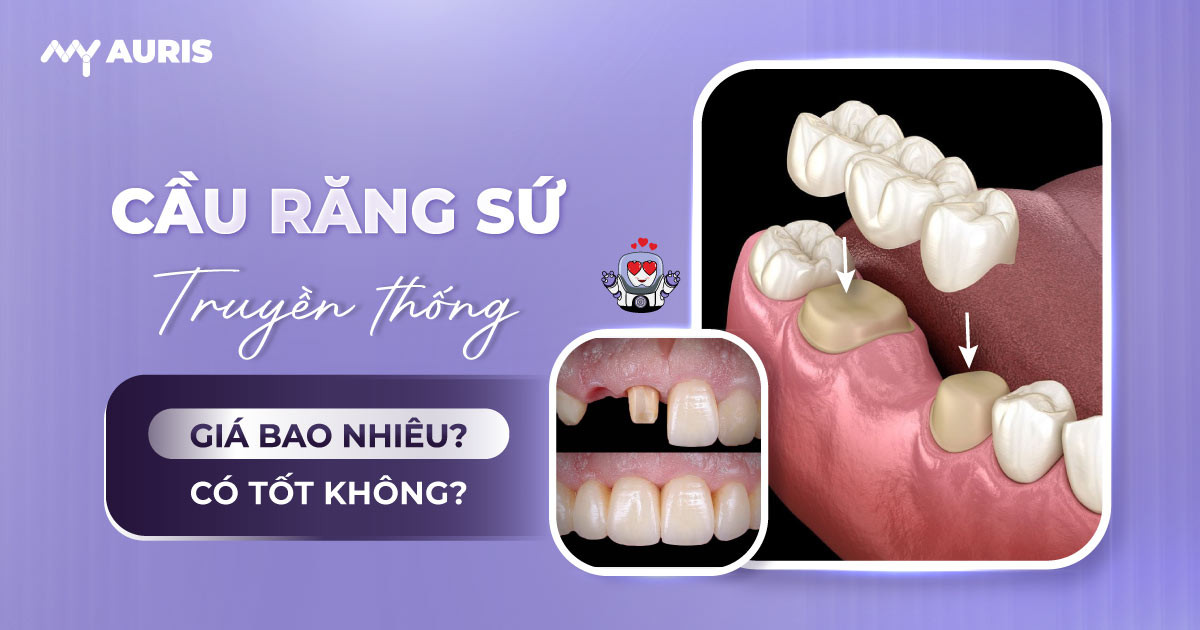 Cầu Răng Sứ Truyền Thống