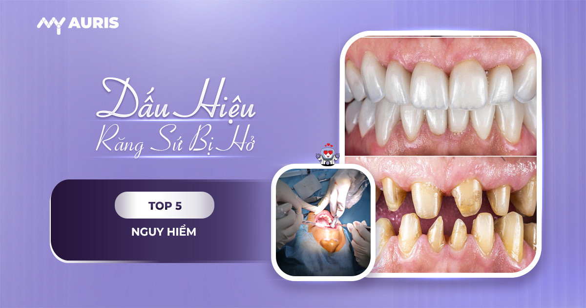 dấu hiệu răng sứ bị hở
