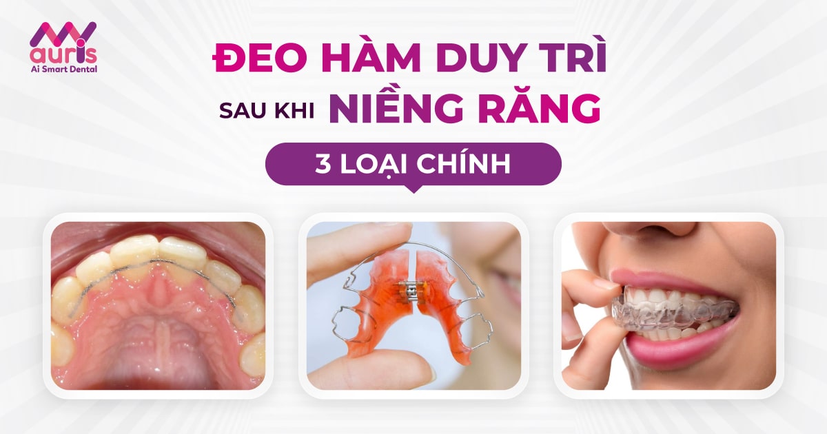 Đeo hàm duy trì sau niềng răng cùng 3 loại chính