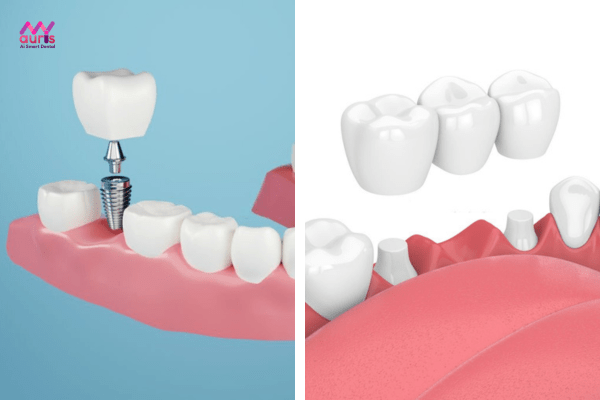 So sánh cầu răng sứ và implant 