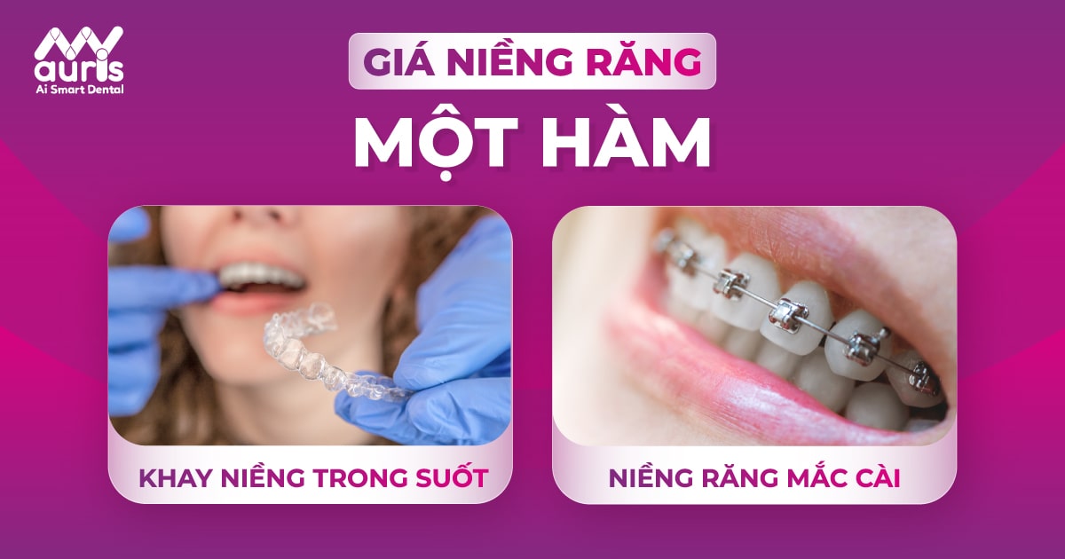 Giá niềng răng một hàm bao nhiêu? (Chi tiết 2 kỹ thuật)