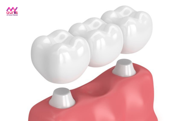 Làm cầu răng sứ thời gian tiêu xương bao lâu? 