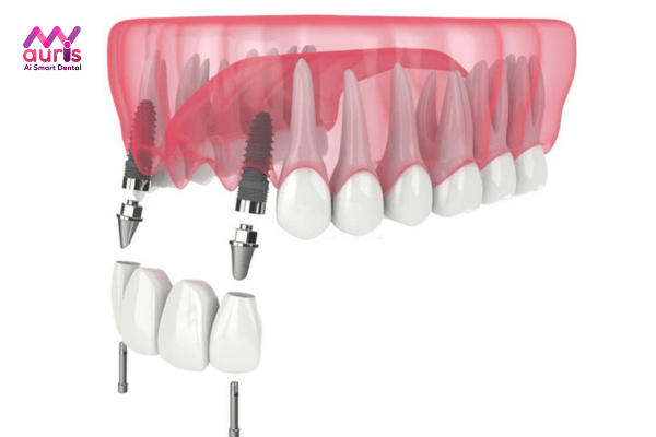 Làm răng giả hàm trên - Trồng răng Implant