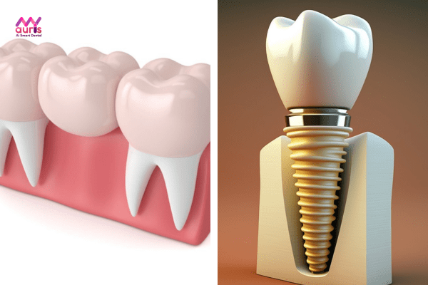 Làm cầu răng sứ hay cấy ghép implant khi bị mất răng?  