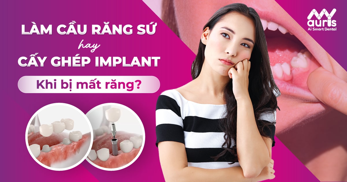 Làm cầu răng sứ hay cấy ghép implant khi bị mất răng?