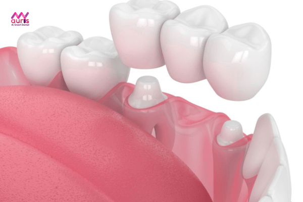 Làm cầu răng sứ có sử dụng được mãi mãi không? 