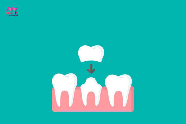 Làm răng bắc cầu trồng thêm răng sứ có được không? 