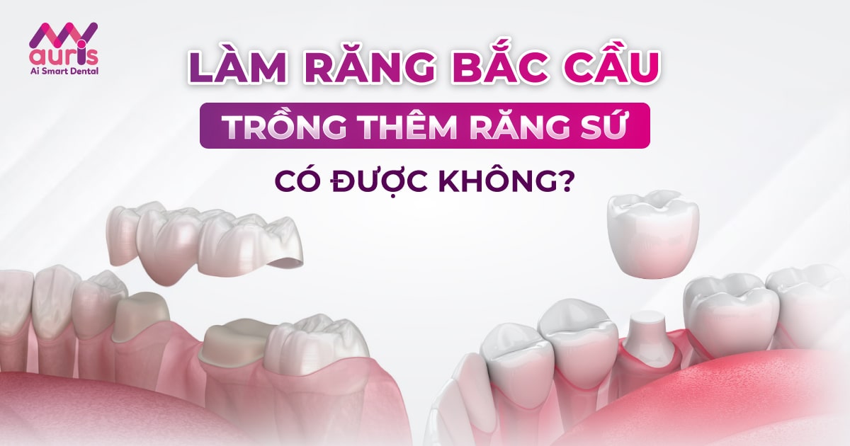 Bọc răng sứ dính liền có ưu điểm gì so với các phương pháp khác?
