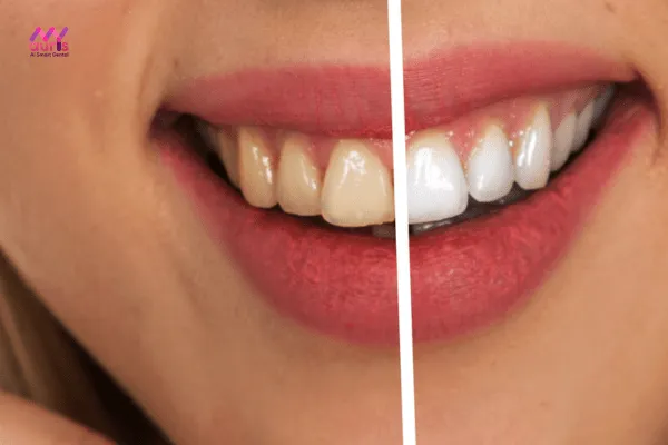 Bọc răng sứ thẩm mỹ - Trường hợp làm răng giả không cần lấy tủy 