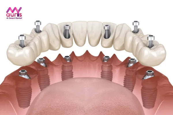 Làm răng giả giá bao nhiêu với kỹ thuật trồng răng Implant 