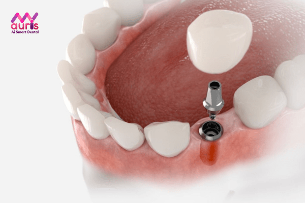 Làm răng giả bằng trồng răng Implant