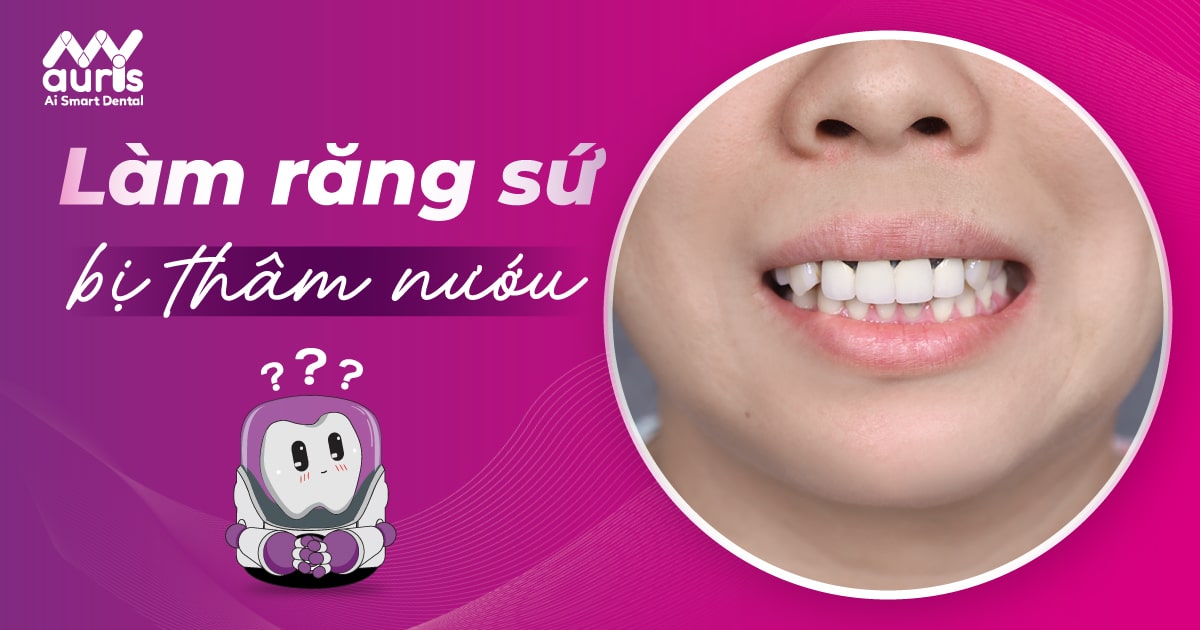 Vì sao làm răng sứ bị thâm nướu? (4 nguyên nhân chính)