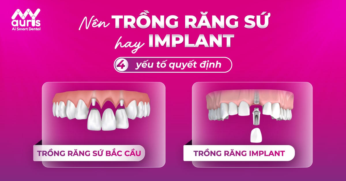 Nên trồng răng sứ hay Implant - 4 yếu tố quyết định